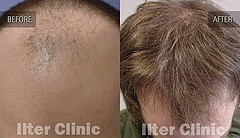 hair replacement