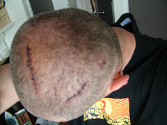 head scar